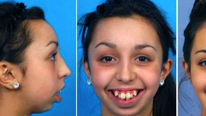 it-took-20-years-before-she-could-afford-surgery-to-fix-her-deformity-how-she-looks-today-stunning0